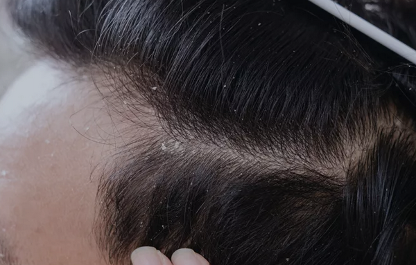 5 Cara Mencegah Ketombe Akibat Aktivitas Fisik yang Intens