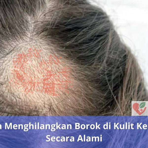 Cara Menghilangkan Borok di Kulit Kepala Secara Alami