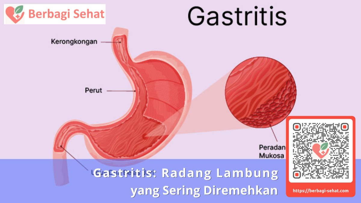 Gastritis: Radang Lambung yang Sering Diremehkan 1 Gastritis Radang Lambung yang Sering Diremehkan - Iritasi Lambung