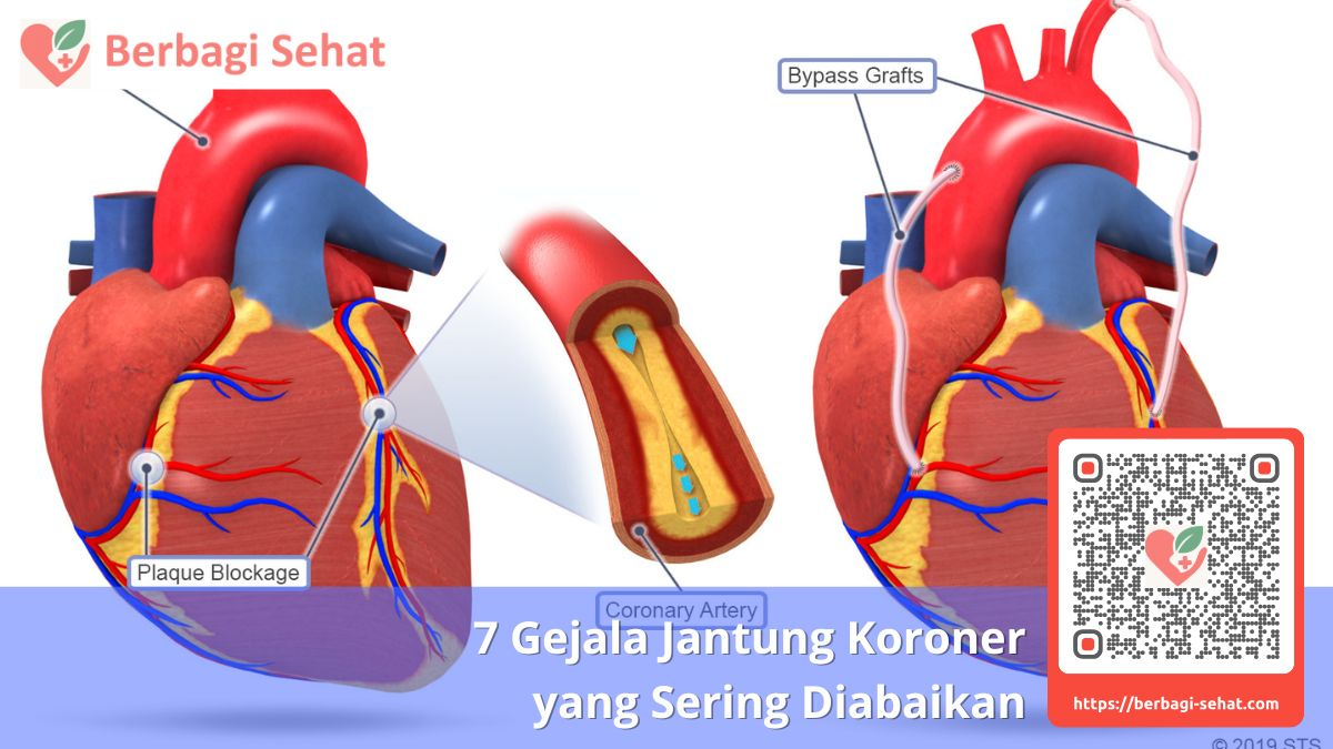 7 Gejala Jantung Koroner yang Sering Diabaikan 3 Kapan Harus Segera ke Dokter Jantung