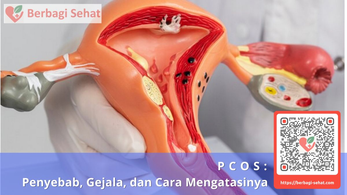 PCOS: Penyebab, Gejala, dan Cara Mengatasinya 1 PCOS Penyebab Gejala dan Cara Mengatasinya apa itu pcos