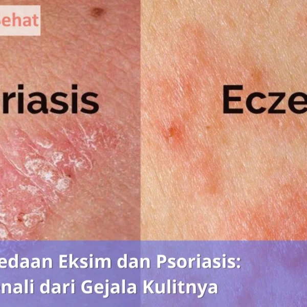 Perbedaan Eksim dan Psoriasis Kenali dari Gejala Kulitnya