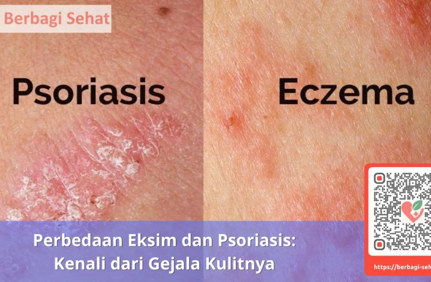Perbedaan Eksim dan Psoriasis Kenali dari Gejala Kulitnya