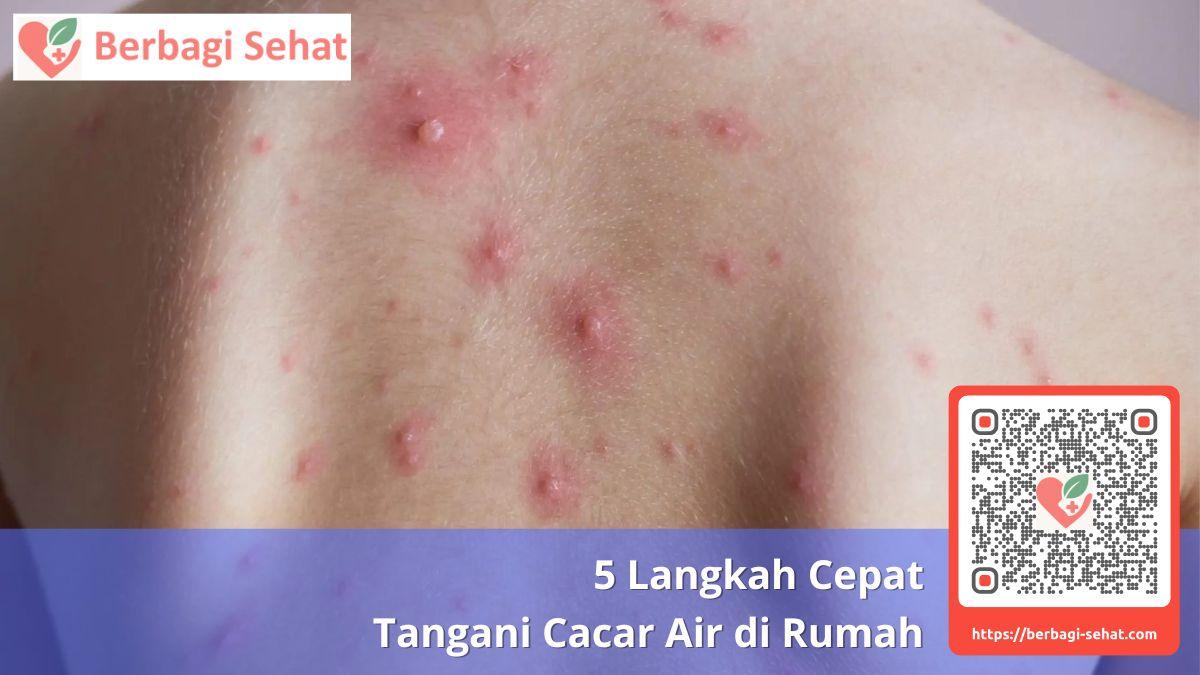 5 Langkah Cepat Tangani Cacar Air di Rumah 1 Mengenali Gejala Cacar Air