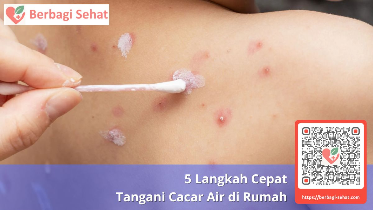 5 Langkah Cepat Tangani Cacar Air di Rumah 4 Pencegahan Penularan pada Anggota Keluarga Lain