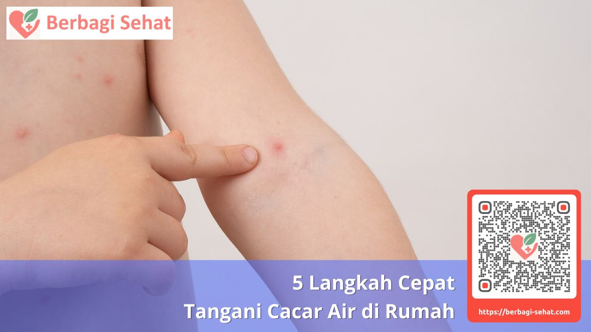 5 Langkah Cepat Tangani Cacar Air di Rumah 5 Perawatan Pasca Sembuh Dari Cacar Air