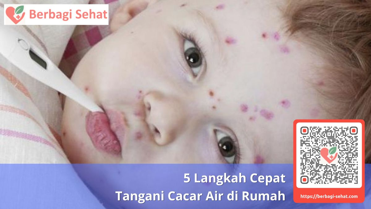 5 Langkah Cepat Tangani Cacar Air di Rumah 3 Tanda Bahaya Cacar Air yang Memerlukan Bantuan Medis