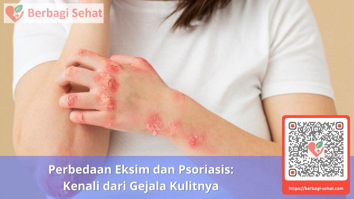 Perbedaan Eksim dan Psoriasis Kenali dari Gejala Kulitnya Apa Itu Eksim