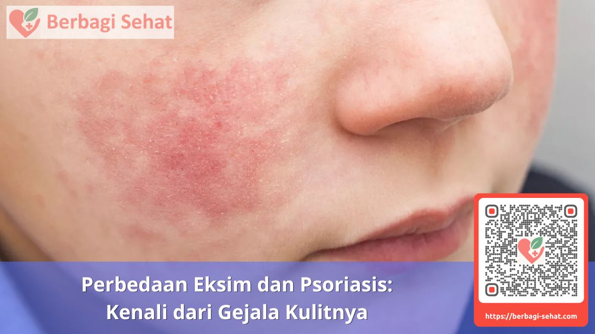 Perbedaan Eksim dan Psoriasis Kenali dari Gejala Kulitnya Eksim di Wajah