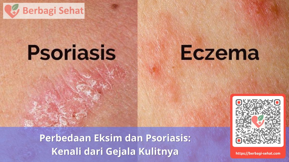 Perbedaan Eksim dan Psoriasis Kenali dari Gejala Kulitnya