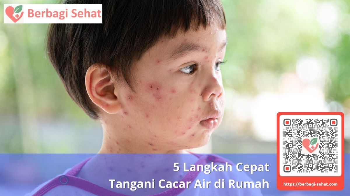 5 Langkah Penanganan Cepat Cacar Air